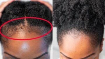 Grow Your Hair Line In Just 2 Weeks With These Steps