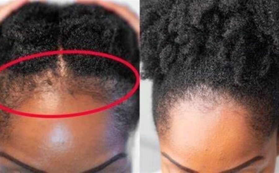 Grow Your Hair Line In Just 2 Weeks With These Steps