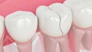 How to Remove Deep Brown Stains From Teeth Using Common Kitchen Ingredients