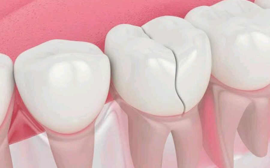 How to Remove Deep Brown Stains From Teeth Using Common Kitchen Ingredients