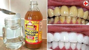 Seé what happens when you apply vinegar on your teeth