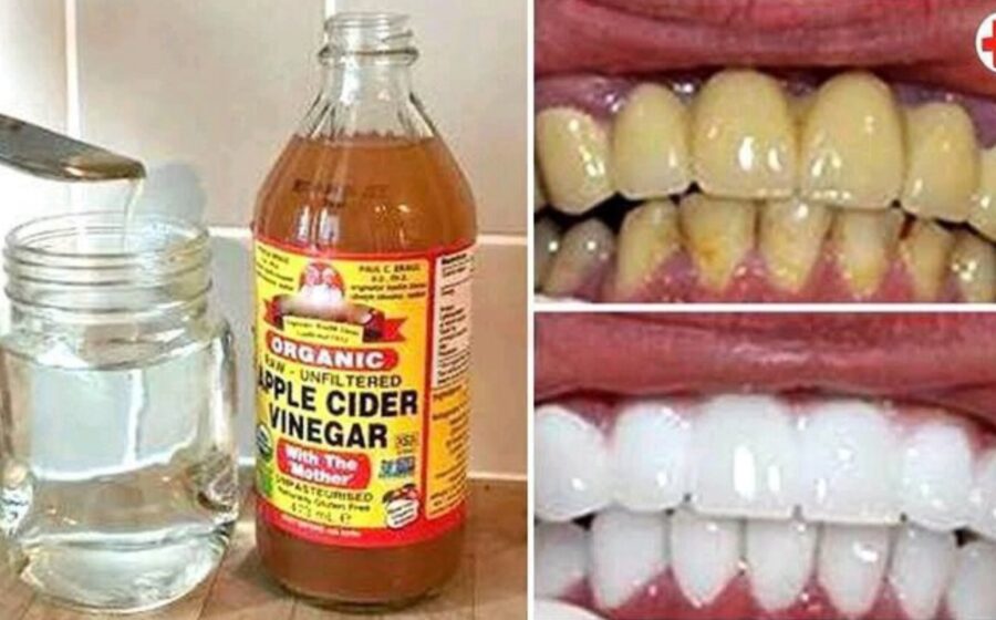 Seé what happens when you apply vinegar on your teeth