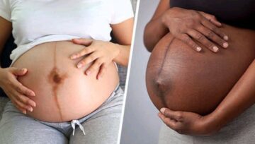 WhatThe Dark Straight Line On A Pregnant Woman’s Stomach Mean