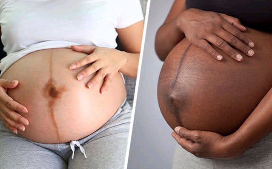 WhatThe Dark Straight Line On A Pregnant Woman’s Stomach Mean