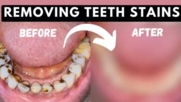 How To Remove Deep Brown Stains From Your Teeth With These Kitchen Ingredients